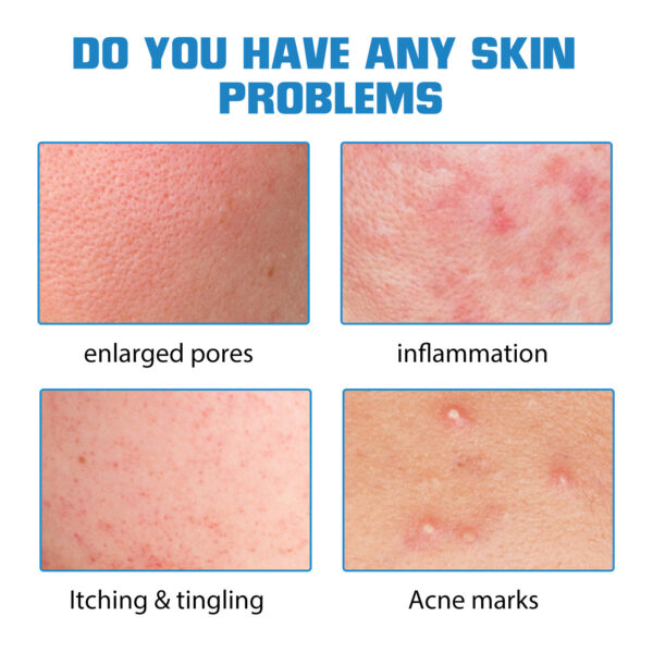 Hyaluronic Acid Replenishment - Image 8