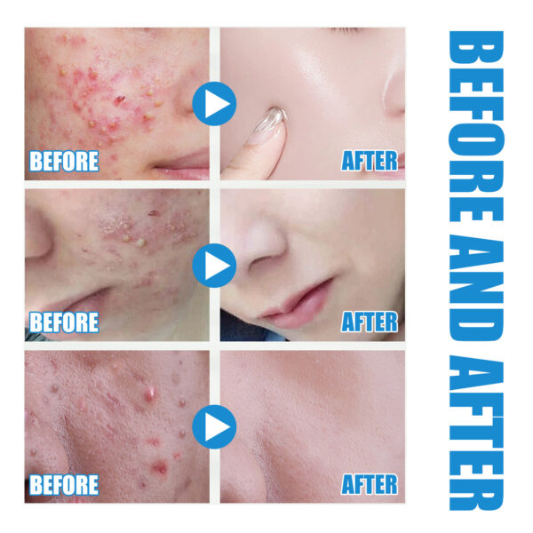 Hyaluronic Acid Replenishment - Image 6